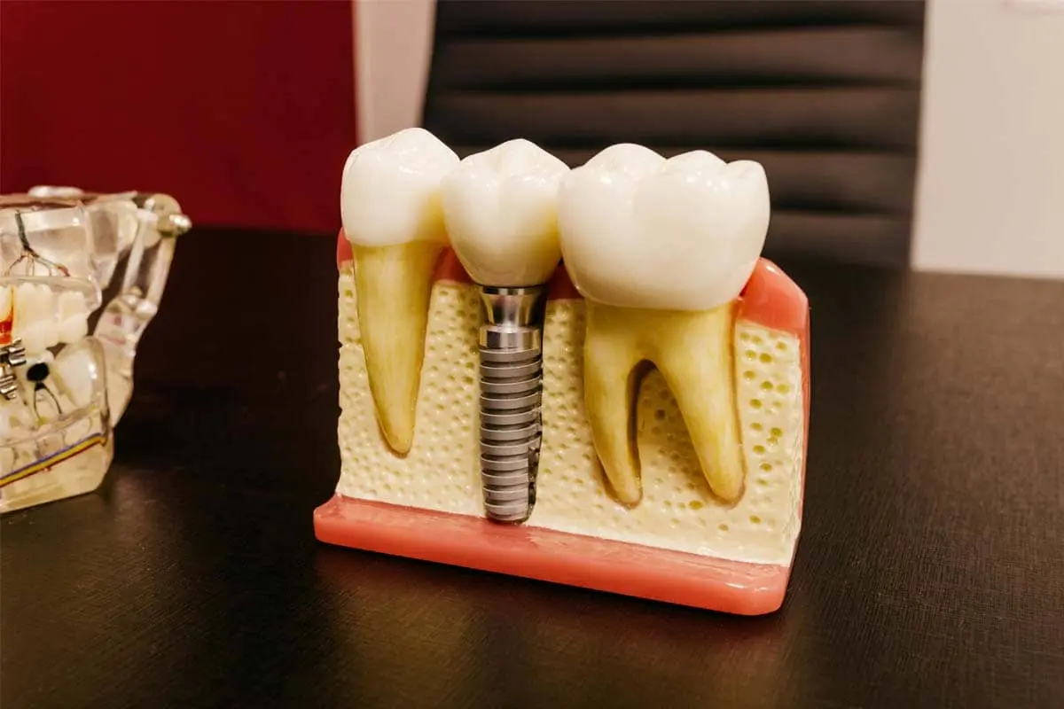 Single Tooth Implant Cost Without Insurance 2024